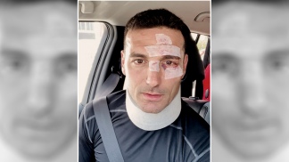 Scaloni fue dado de alta tras ser atropellado por un auto